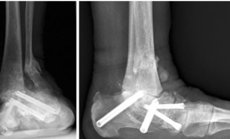 How Does Triple Arthrodesis At Scottsdale, AZ Foot Improve Ankle Function