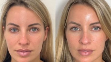 How Can Sculptra Injections Sculpt A More Radiant And Youthful You