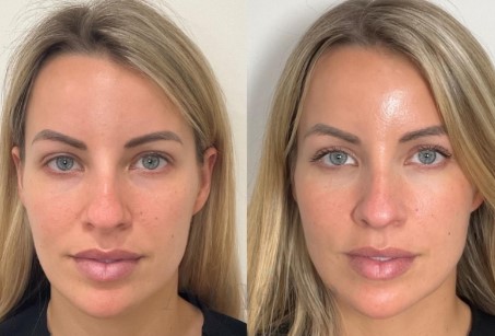 How Can Sculptra Injections Sculpt A More Radiant And Youthful You