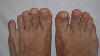 What Are The Benefits Of Bunionette Correction At Foot And Ankle Center Of Arizona