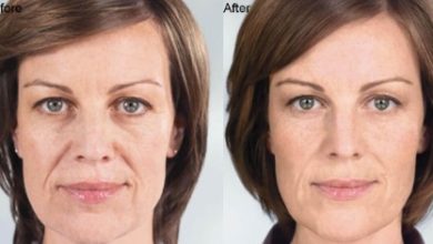 Where Can I Find Information About the Cost of Sculptra