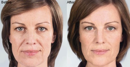 Where Can I Find Information About the Cost of Sculptra