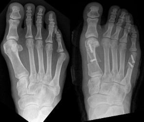 10 Benefits of Minimally Invasive Bunion Surgery Find Out