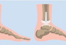 What Are the Benefits of Total Ankle Replacement Surgery