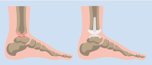 What Are the Benefits of Total Ankle Replacement Surgery