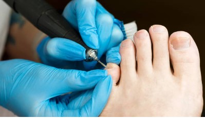 Where to Get the Best Toenail Removals Find