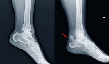 Where To Get Metatarsal Fracture Surgery in AZ