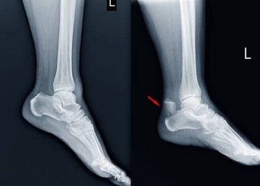 Where To Get Metatarsal Fracture Surgery in AZ