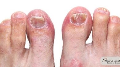 How To Get Rid Of A Toe Infection