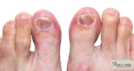 How To Get Rid Of A Toe Infection