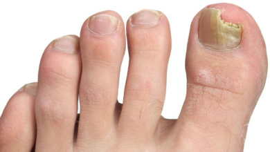 How to Heal a Toe Infection Without Antibiotics