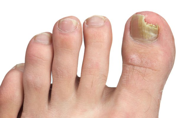 How to Heal a Toe Infection Without Antibiotics